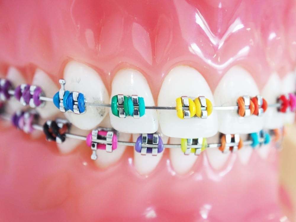 orthodontist braces color wheel
