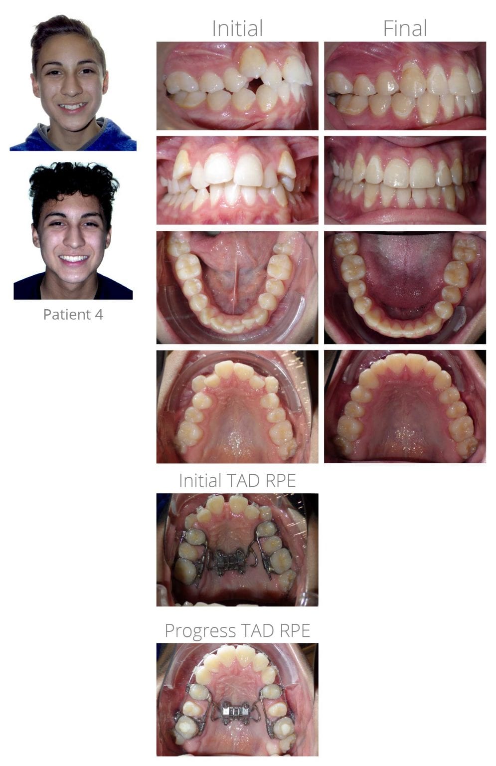 Teen Braces Patient 4 After - Orthodontic Arts