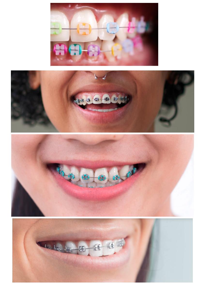 Braces Colours: How to Choose the Best Braces Colour for Your Teeth