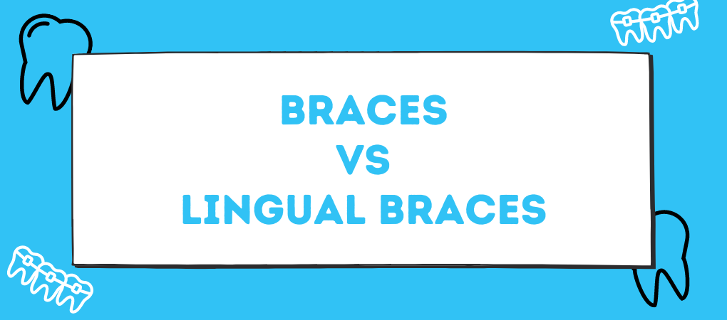 Braces vs Lingual Braces Orthodontic Arts OKC.