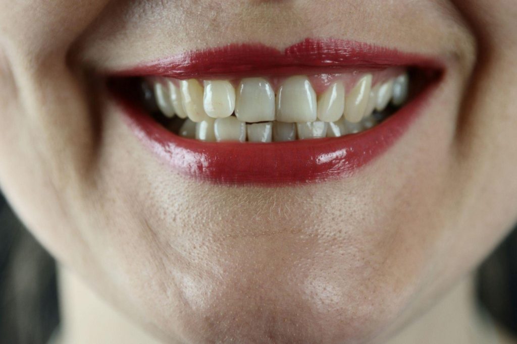 How to tell if you need braces misaligned teeth